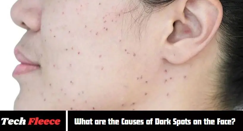 What are the Causes of Dark Spots on the Face